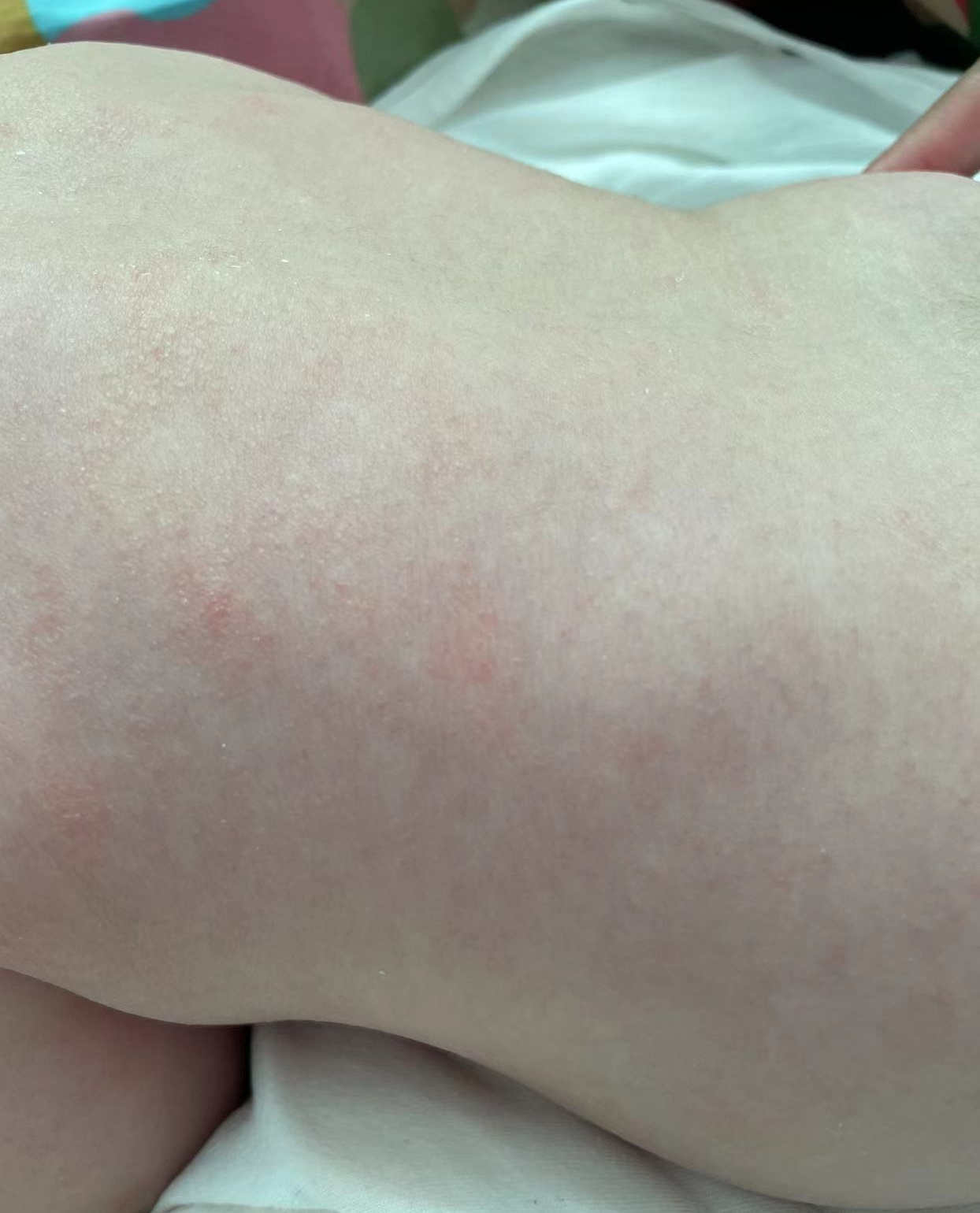 婴儿衣服过敏